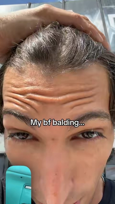 I am not having a bald boyfriend #hairgrowth #balding #menshair 