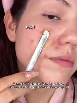 My skin transformation is crazier than any filter 🤯#acnetreatment #tiktokshopstockup #CityTasteTest #drleohonestreview #glowingskin 