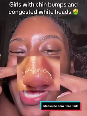 I saw results in 1 week   #medicube #whiteheads #pores #sebaceousfilament #tiktokshopcreatorpicks 