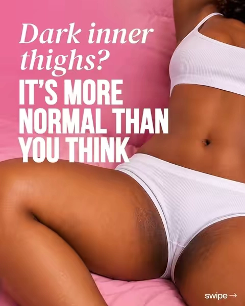 Darker isn’t dirty. If your inner thighs are darker than the rest of you, stop scrubbing and read this. 🛑 Scrubbing won’t lighten them. Irritated skin can darken as it heals, so harsh scrubs and DIY “lighteners” may make things worse. Here’s a few things that may be going on: 🔸 Your thighs rub as you move 🔸 Dull razors scrape and irritate your skin 🔸 Hormones shift during your cycle and pregnancy 🔸 Sweat gets trapped beneath tight clothing 🔸 Dry skin chafes more easily None of that means you’re not clean. It means you’re human.  A gentler thigh routine: ✨ Everywhere Deodorant in the morning. Niacinamide + mandelic acid help fade and even the look of dark areas. Skip it on shave days. ✨ Renew Her Oil at night to moisturize dry, rubbing skin and help prevent new #hyperpigmentation  ✨ Use a new razor every 5–7 shaves. ✨ Wear bike shorts under dresses to reduce rubbing. Give your routine time. Consistency beats scrubbing. ⚠️ Swipe to the last slide for the sign that means it’s time to see your doctor. 📌  Find Renew Her at CVS or shop both at herfantasybox.com. Fantasy Baes, be honest: were you scrubbing too? 👇