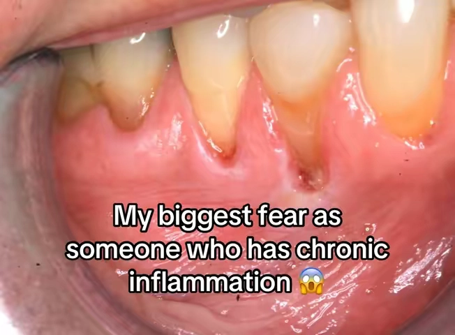 Did you know chronic inflammation and autoimmune can impact your dental health as well?  Disclaimer: not medical advice, please refer to your dentist for further advice. This is my personal experience, results vary. 